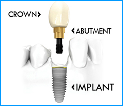 Single tooth implant at Kreativ Dental