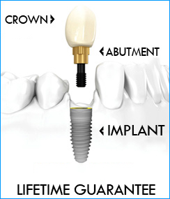 Dental Implants Preparation Abroad at Kreativ Dental