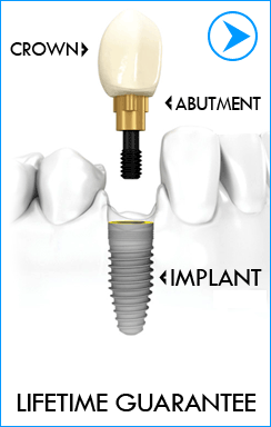 Dental Implants Preparation Abroad at Dental center Dr. Batkoski