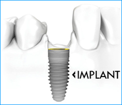 Dental Implant overseas