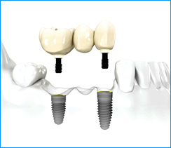 Dental Implants Preparation in Hungary